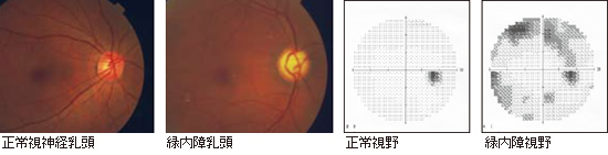 緑内障・正常眼圧緑内障・緑内障乳頭・正常視野・緑内障視野